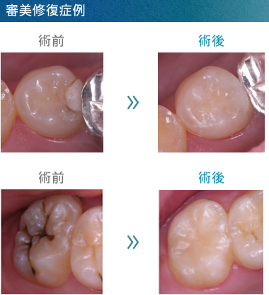 虫歯の治療