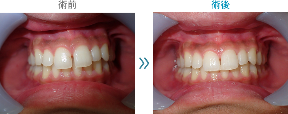 ダイレクトボンディング　治療症例１