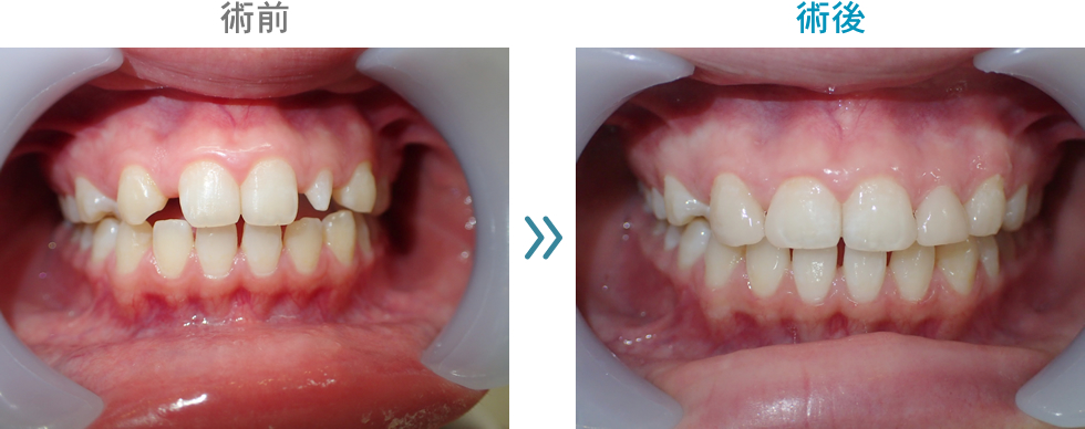 ダイレクトボンディング　治療症例２